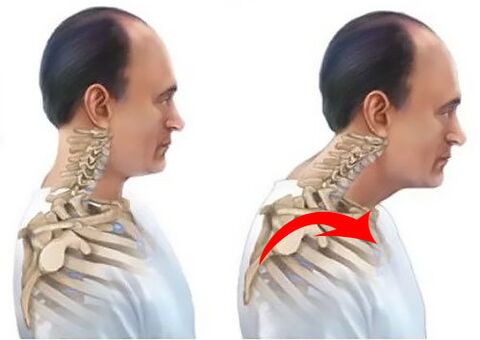 A healthy and painful spine