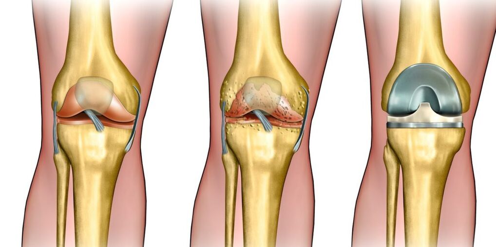 Arthrosis of the knee joint